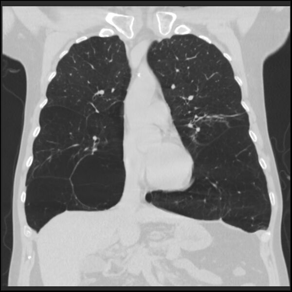 File:Alpha-1-antitrypsin deficiency (Radiopaedia 40993-43722 Coronal lung window 38).jpg