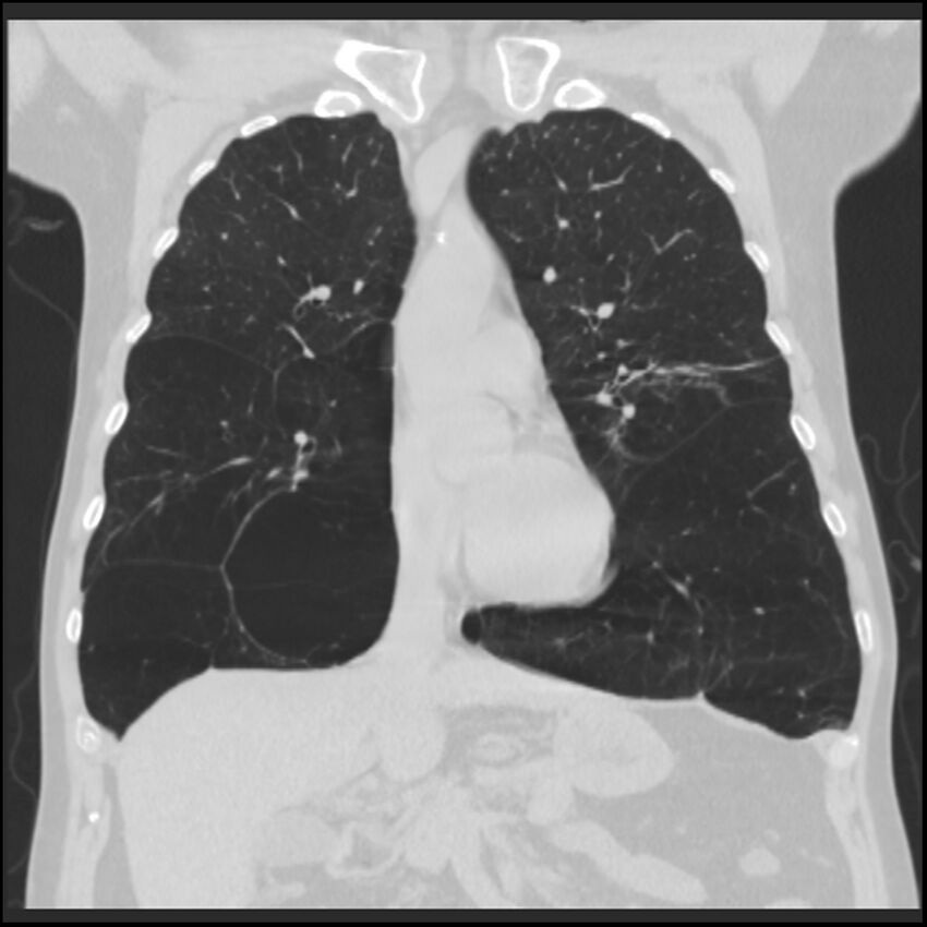 Alpha-1-antitrypsin deficiency (Radiopaedia 40993-43722 Coronal lung window 38).jpg