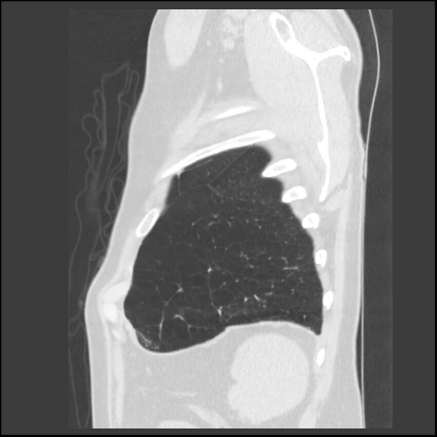 Alpha-1-antitrypsin deficiency (Radiopaedia 40993-43722 Sagittal lung window 30).jpg