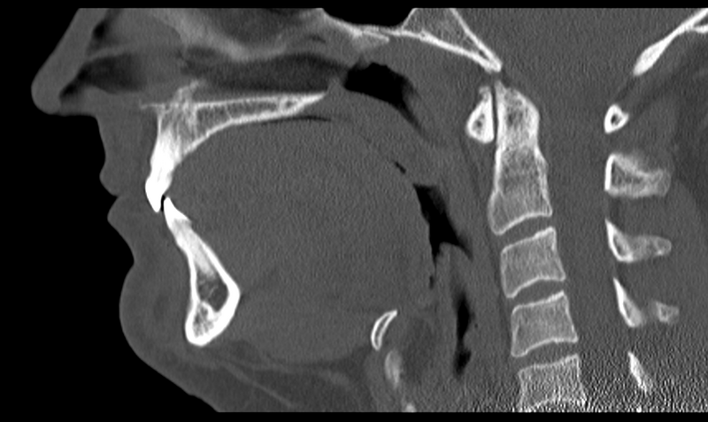 File:Ameloblastoma (Radiopaedia 33677-34806 Sagittal bone window 34).png