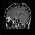 Amnestic syndrome secondary to hypoxic brain injury (Radiopaedia 24743-25004 D 16).jpg