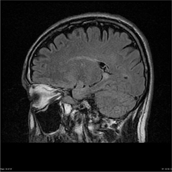 File:Amnestic syndrome secondary to hypoxic brain injury (Radiopaedia 24743-25004 D 16).jpg