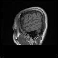 Amnestic syndrome secondary to hypoxic brain injury (Radiopaedia 24743-25004 T1 18).jpg