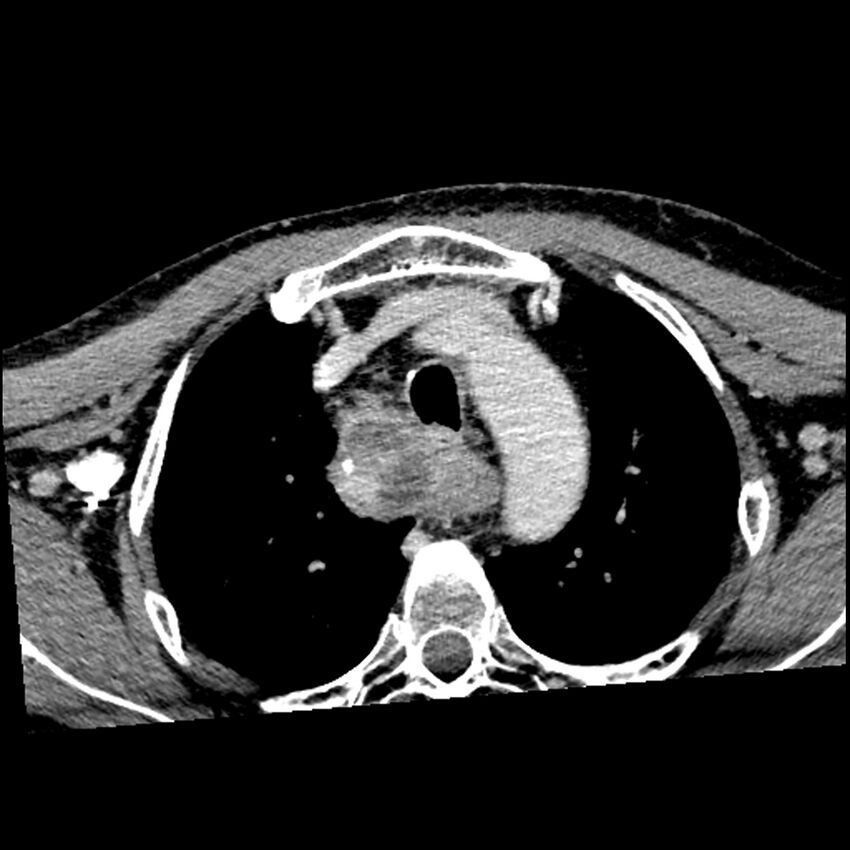 Anaplastic thyroid carcinoma (Radiopaedia 79087-92034 B 11).jpg