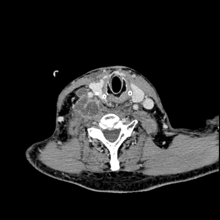 Anaplastic thyroid carcinoma (Radiopaedia 79087-92034 B 51).jpg