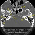 Anatomy Quiz (Skull base) (Radiopaedia 41833).jpeg