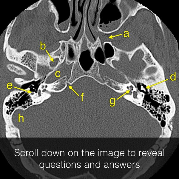 File:Anatomy Quiz (Skull base) (Radiopaedia 41833).jpeg