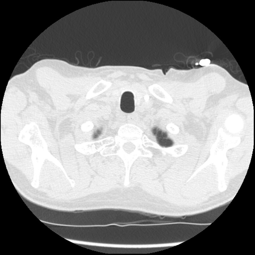 Angioinvasive aspergillosis (Radiopaedia 43957-47466 Axial lung window 7).jpg