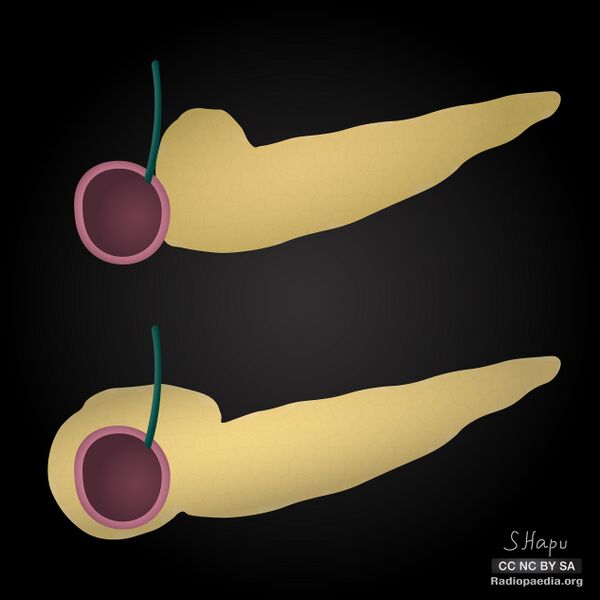 File:Annular pancreas (illustrations) (Radiopaedia 55824-62411 B 1).jpg