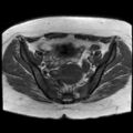 Ano-vaginal fistula (Radiopaedia 29765-30284 Axial T1 23).jpg