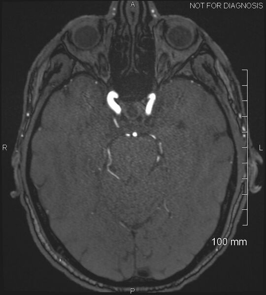 File:Anterior cerebral artery aneurysm (Radiopaedia 80683-94127 Axial MRA 84).jpg