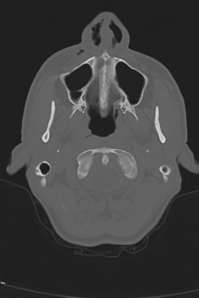 File:Anterior nasal spine fracture (Radiopaedia 46138-50494 Axial bone window 54).png