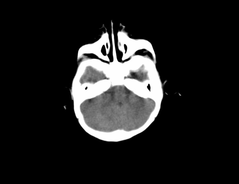 File:Anterior plagiocephaly (Radiopaedia 71836-82273 Axial non-contrast 3).jpg