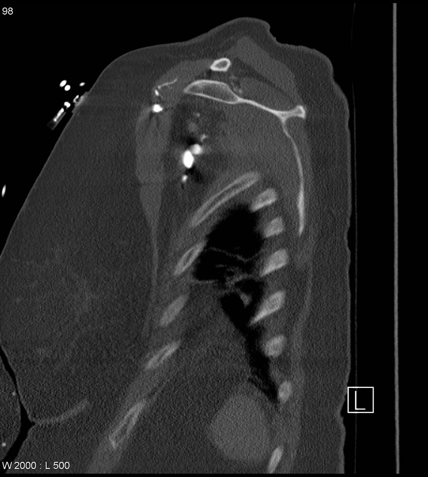 Anterior shoulder dislocation (CT) (Radiopaedia 59032-66309 Sagittal bone window 49).jpg