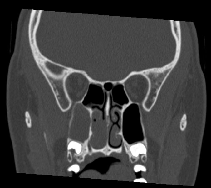 File:Antrochoanal polyp (Radiopaedia 21894-21868 Coronal bone window 20).jpg