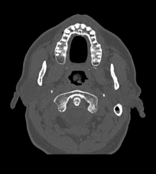 File:Antrochoanal polyp (Radiopaedia 79011-92169 Axial bone window 3).jpg