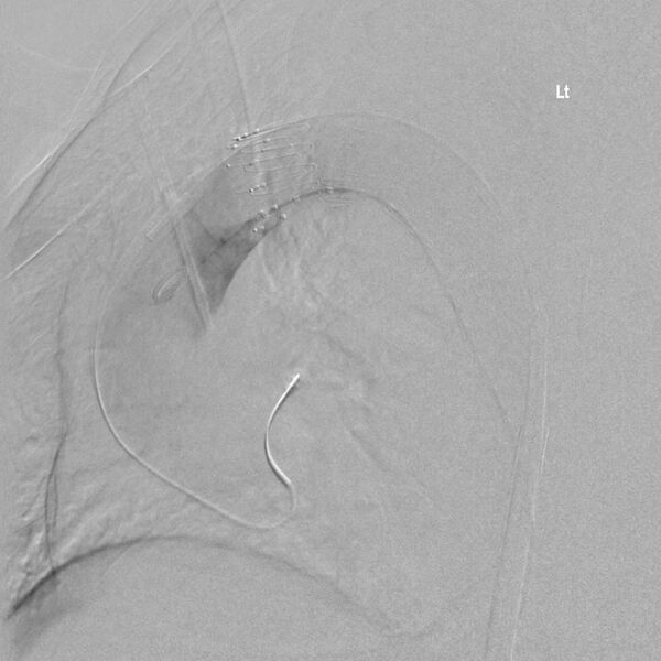 File:Aortic arch false aneurysm (Radiopaedia 14667-14589 Final result 2).jpg