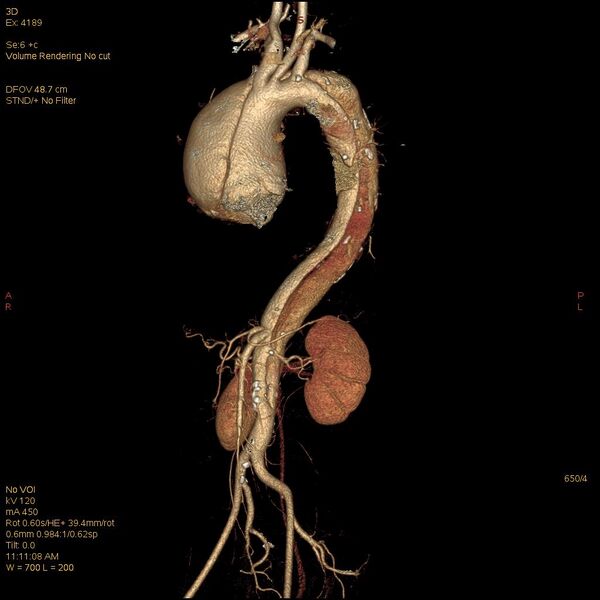 File:Aortic dissection (Radiopaedia 25350-25604 E 4).jpg