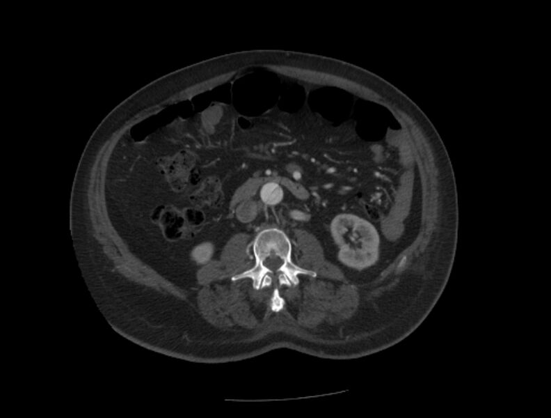 File:Aortic dissection (Radiopaedia 28802-29105 A 63).jpg
