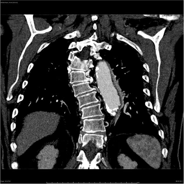 File:Aortic dissection - Stanford type A (Radiopaedia 26183-26315 A 56).jpg