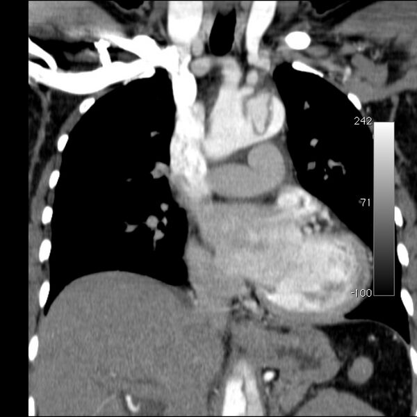 File:Aortic dissection - Stanford type A (Radiopaedia 29247-29659 B 29).jpg