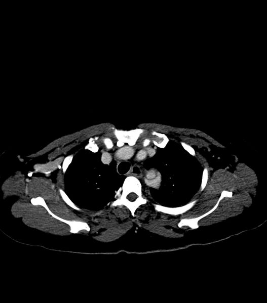 File:Aortic dissection with renal ischemia (Radiopaedia 76573-88338 B 7).jpg