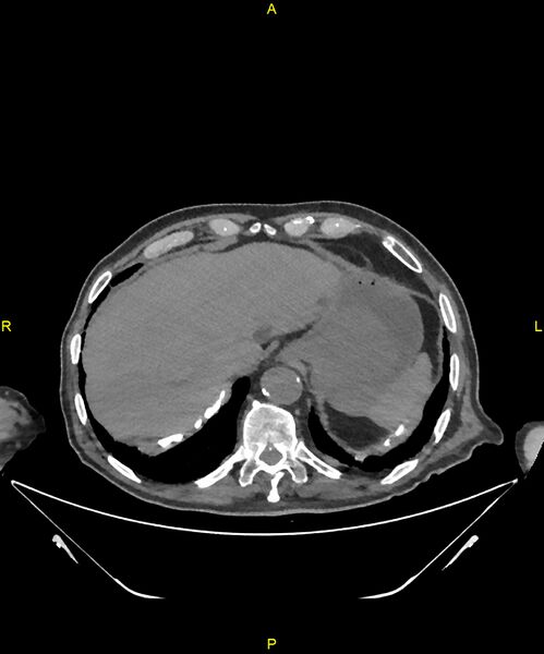 File:Aortoenteric fistula (Radiopaedia 84308-99603 Axial non-contrast 36).jpg