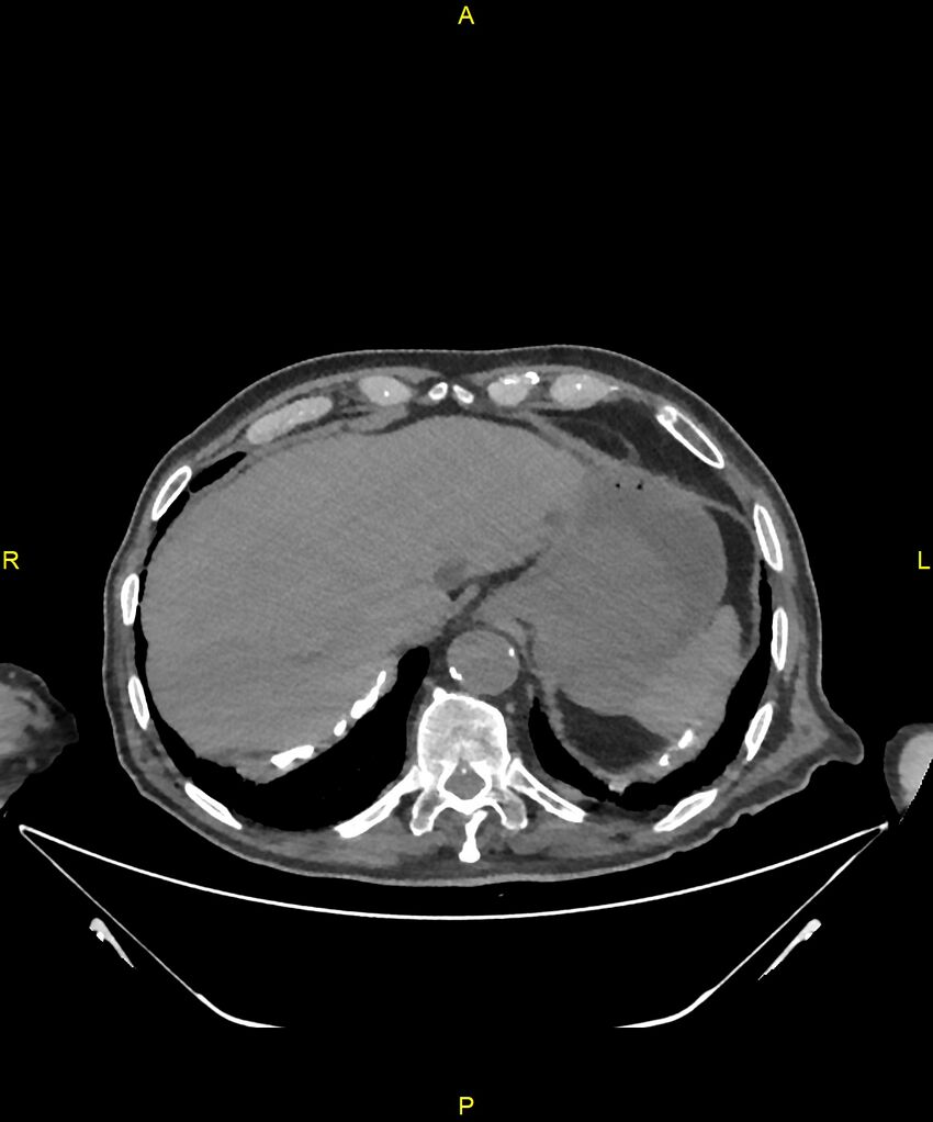 Aortoenteric fistula (Radiopaedia 84308-99603 Axial non-contrast 36).jpg