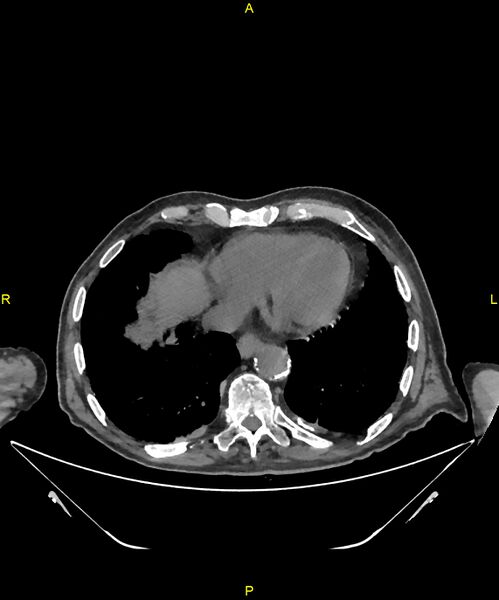 File:Aortoenteric fistula (Radiopaedia 84308-99603 Axial non-contrast 4).jpg