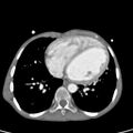 Aortopulmonary window, interrupted aortic arch and large PDA giving the descending aorta (Radiopaedia 35573-37074 B 61).jpg