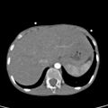 Aortopulmonary window, interrupted aortic arch and large PDA giving the descending aorta (Radiopaedia 35573-37074 B 88).jpg