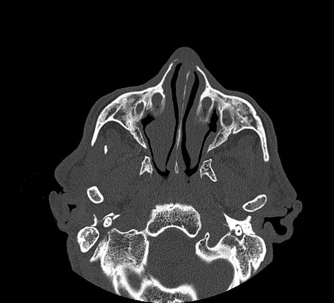 File:Aplastic maxillary sinuses (Radiopaedia 60030-67561 Axial non-contrast 30).jpg