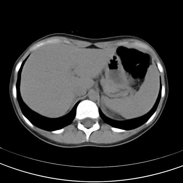 File:Appendicitis and incidental bicornuate uterus (Radiopaedia 22833-22853 Axial non-contrast 10).jpg