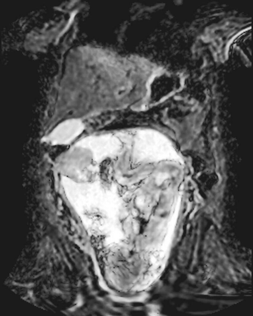 Appendicitis in gravida (MRI) (Radiopaedia 89433-106395 Coronal ADC 21).jpg