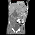 Appendicitis with phlegmon (Radiopaedia 9358-10046 B 28).jpg