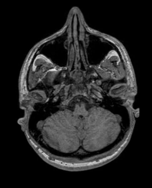 File:Arachnoid cyst- extremely large (Radiopaedia 68741-78451 Axial T1 16).jpg