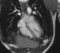 Arrhythmogenic right ventricular cardiomyopathy (Radiopaedia 39806-42237 D 110).jpg
