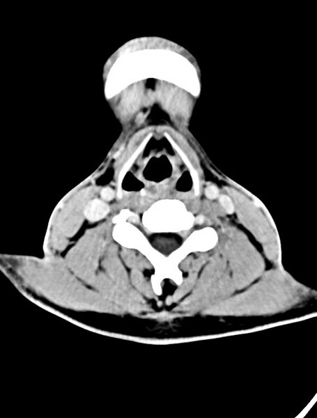 File:Arrow injury to the face (Radiopaedia 73267-84011 Axial C+ delayed 8).jpg