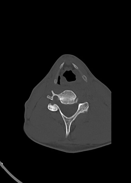 File:Arrow injury to the head (Radiopaedia 75266-86388 Axial bone window 2).jpg