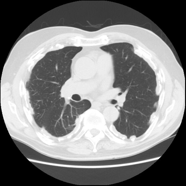 File:Asbestos-related pleural plaques (Radiopaedia 39069-41255 Axial lung window 36).jpg