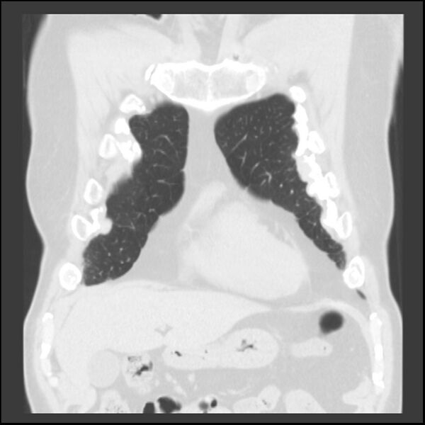 File:Asbestos-related pleural plaques (Radiopaedia 39069-41255 Coronal lung window 73).jpg