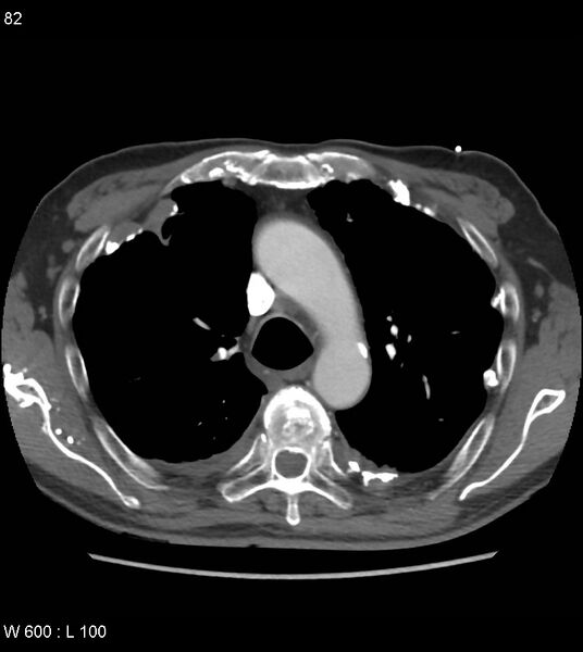 File:Asbestos related lung and pleural disease (Radiopaedia 14377-14301 D 18).jpg