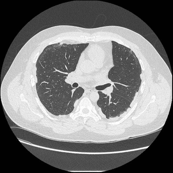 File:Asbestosis (Radiopaedia 45002-48961 Axial lung window 24).jpg