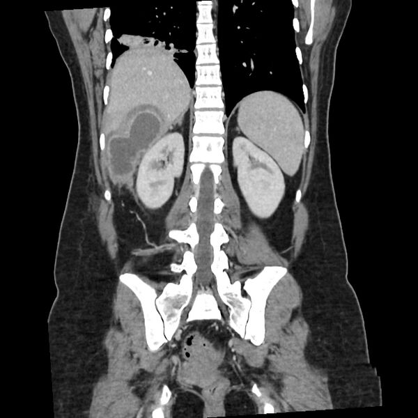 File:Ascending retrocecal appendicitis with liver abscesses (Radiopaedia 60066-67615 C 7).jpg