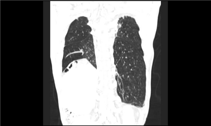 File:Aspergilloma (Radiopaedia 20788-20701 Coronal lung window 15).jpg