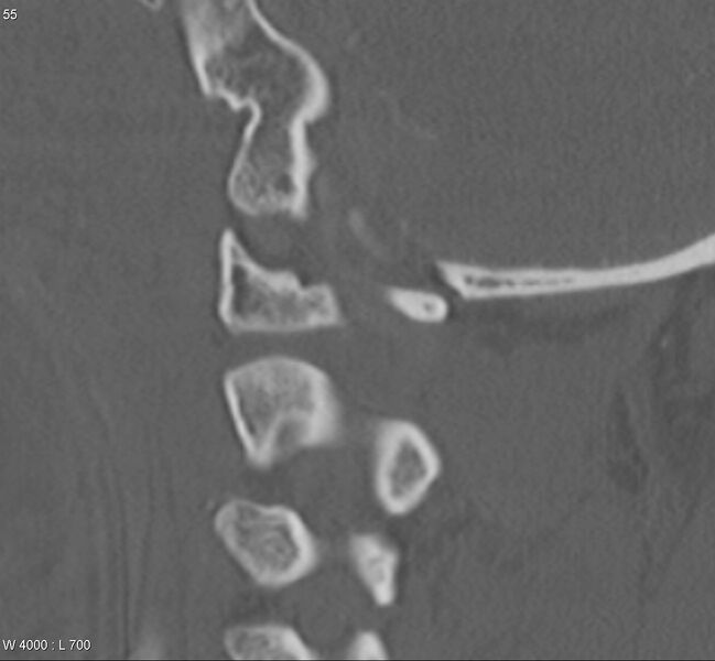 File:Atlanto-axial separation (Radiopaedia 4600-6704 Sagittal bone window 2).jpg