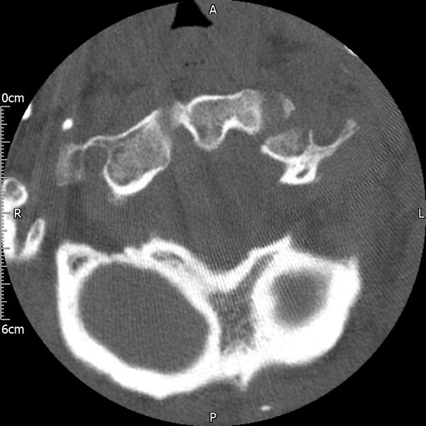 File:Atlas fracture with Currarino type A congenital defect (Radiopaedia 71747-82144 Axial bone window 38).jpg