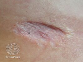 Atrophic scar