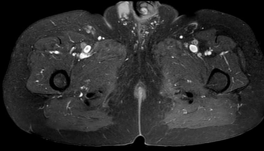Atypical lipomatous tumor - thigh (Radiopaedia 68975-78734 Axial T1 C+ fat sat 78).jpg