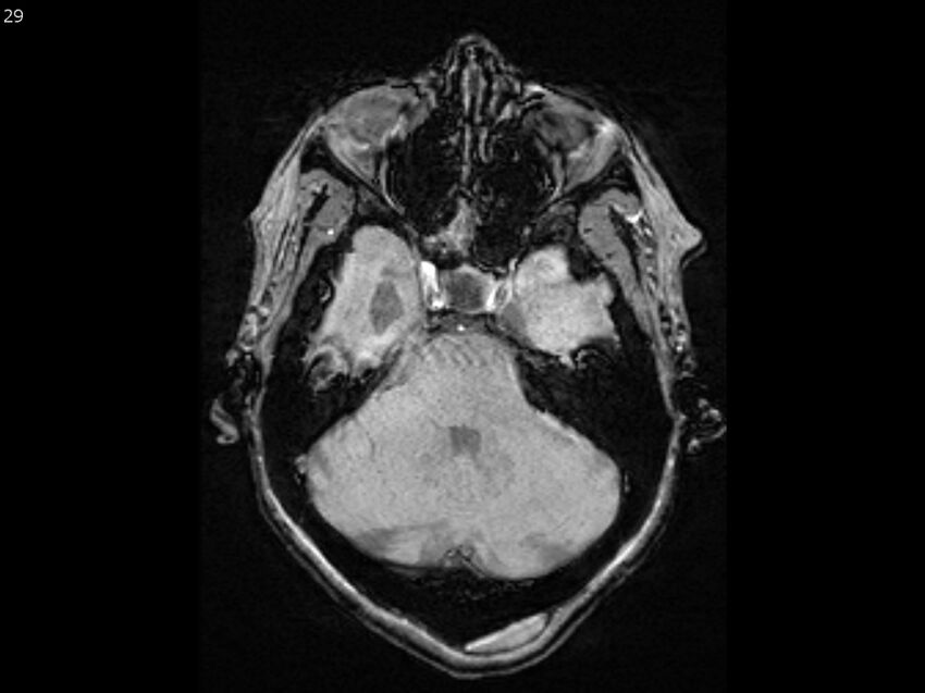 Atypical meningioma - intraosseous (Radiopaedia 64915-74572 Axial SWI 29).jpg